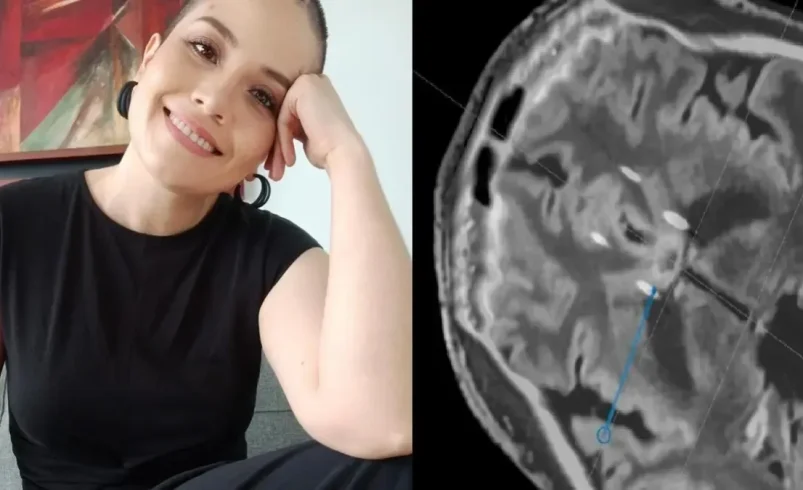 ¿Hay cirugía para mejorar la depresión? La historia de la mujer que se sometió a un procedimiento cerebral pionero

 – Tinta clara