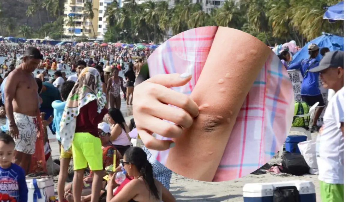 Bathers informa brotes en la piel después de ingresar al mar en Santa Marta; La mujer afectada le dice su experiencia

 – Tinta clara