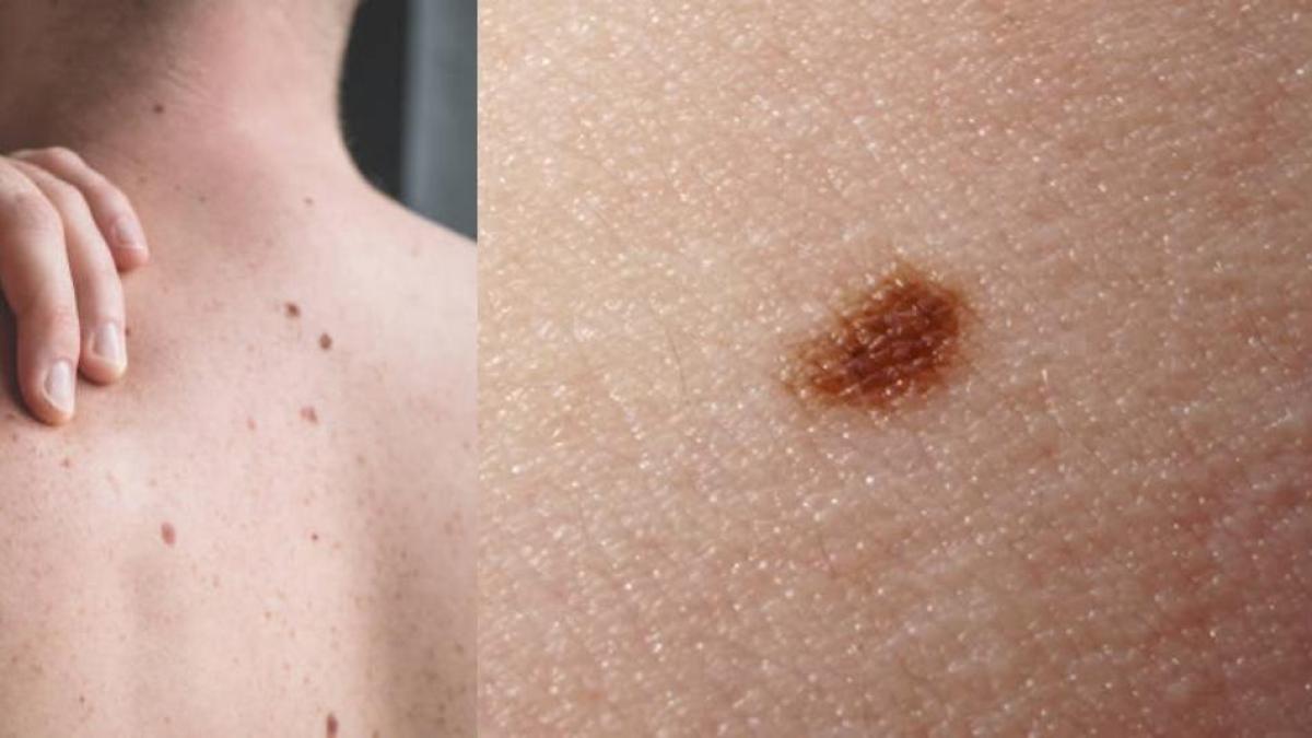 Día de comprobación de luna gratis busca prevenir el cáncer de piel

 – Tinta clara