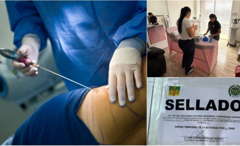 La liposucción clandestina realizada en un balneario de Caldas que dejó en delicado estado de salud a una joven de 26 años y destapó graves irregularidades

 – Tinta clara