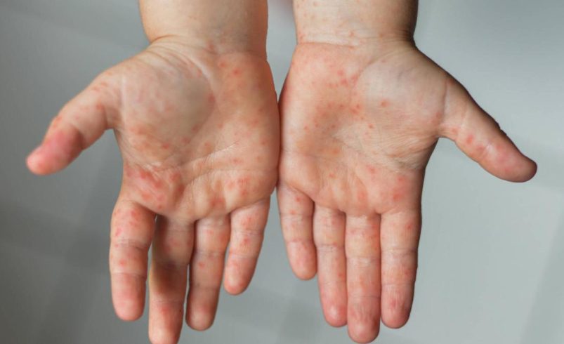 ¿En qué municipio hubo contagio? autoridades encendieron las alarmas

 – Tinta clara